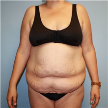 Tummy Tuck Before Photo by Jason Hess, MD; ,  - Case 50257