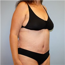 Tummy Tuck After Photo by Jason Hess, MD; ,  - Case 50257