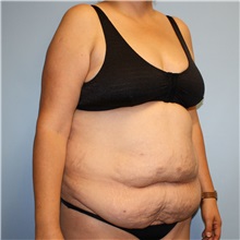 Tummy Tuck Before Photo by Jason Hess, MD; ,  - Case 50257