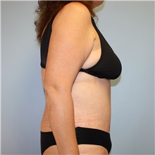 Tummy Tuck After Photo by Jason Hess, MD; ,  - Case 50257