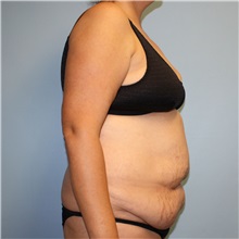 Tummy Tuck Before Photo by Jason Hess, MD; ,  - Case 50257