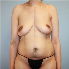 Mommy Makeover Before Photo by Jason Hess, MD; San Diego, CA - Case 50020