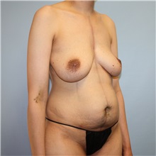 Mommy Makeover Before Photo by Jason Hess, MD; San Diego, CA - Case 50020