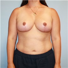 Breast Reduction After Photo by Jason Hess, MD; San Diego, CA - Case 50021 Breast Reduction After Photo by Jason Hess, MD; San Diego, CA - Case 50021
