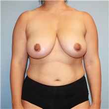 Breast Reduction Before Photo by Jason Hess, MD; San Diego, CA - Case 50021 Breast Reduction Before Photo by Jason Hess, MD; San Diego, CA - Case 50021