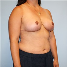 Breast Reduction After Photo by Jason Hess, MD; San Diego, CA - Case 50021