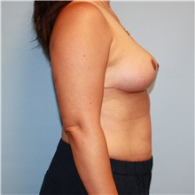 Breast Reduction After Photo by Jason Hess, MD; San Diego, CA - Case 50021