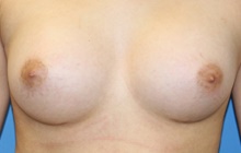 Breast Augmentation After Photo by Wayne Lee, MD; Brandon, FL - Case 46294