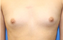 Breast Augmentation Before Photo by Wayne Lee, MD; Brandon, FL - Case 46294