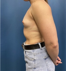 Breast Augmentation Before Photo by Lisa Brostrom, MD; San Antonio, TX - Case 49619