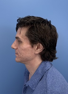 Rhinoplasty After Photo by Lisa Brostrom, MD; San Antonio, TX - Case 49840