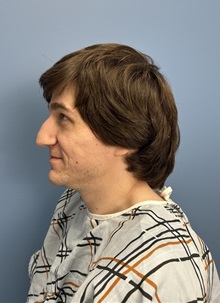 Rhinoplasty Before Photo by Lisa Brostrom, MD; San Antonio, TX - Case 49840