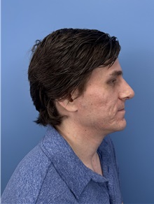 Rhinoplasty After Photo by Lisa Brostrom, MD; San Antonio, TX - Case 49840