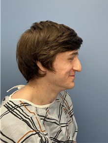 Rhinoplasty Before Photo by Lisa Brostrom, MD; San Antonio, TX - Case 49840