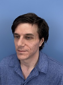 Rhinoplasty After Photo by Lisa Brostrom, MD; San Antonio, TX - Case 49840