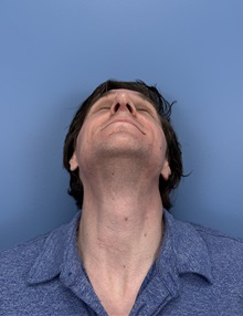 Rhinoplasty After Photo by Lisa Brostrom, MD; San Antonio, TX - Case 49840
