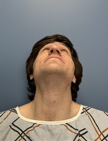 Rhinoplasty Before Photo by Lisa Brostrom, MD; San Antonio, TX - Case 49840