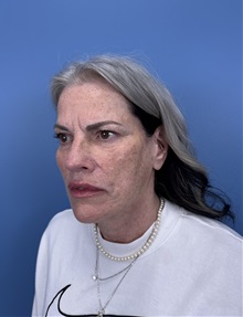Facelift After Photo by Lisa Brostrom, MD; San Antonio, TX - Case 49841 Facelift After Photo by Lisa Brostrom, MD; San Antonio, TX - Case 49841
