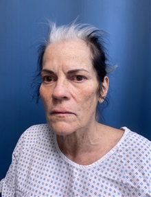 Facelift Before Photo by Lisa Brostrom, MD; San Antonio, TX - Case 49841 Facelift Before Photo by Lisa Brostrom, MD; San Antonio, TX - Case 49841