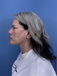 Facelift After Photo by Lisa Brostrom, MD; San Antonio, TX - Case 49841