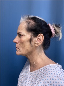 Facelift Before Photo by Lisa Brostrom, MD; San Antonio, TX - Case 49841