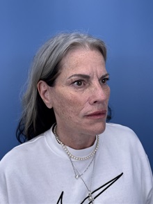 Facelift After Photo by Lisa Brostrom, MD; San Antonio, TX - Case 49841