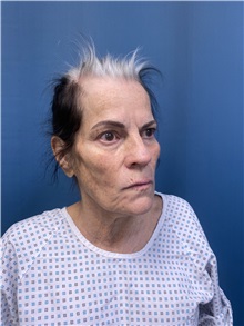Facelift Before Photo by Lisa Brostrom, MD; San Antonio, TX - Case 49841
