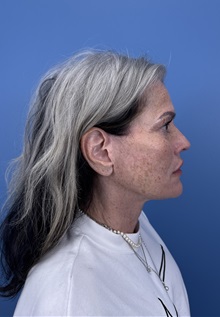 Facelift After Photo by Lisa Brostrom, MD; San Antonio, TX - Case 49841