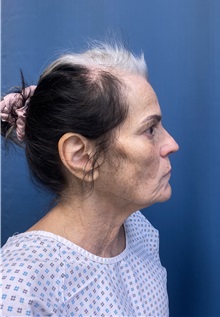 Facelift Before Photo by Lisa Brostrom, MD; San Antonio, TX - Case 49841