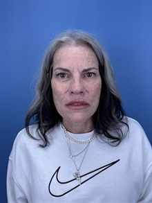 Facelift After Photo by Lisa Brostrom, MD; San Antonio, TX - Case 49841