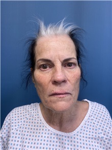 Facelift Before Photo by Lisa Brostrom, MD; San Antonio, TX - Case 49841