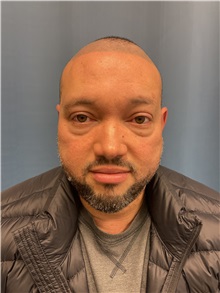 Hair Transplant Before Photo by Lisa Brostrom, MD; San Antonio, TX - Case 49843