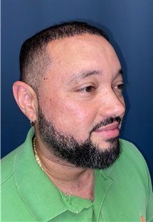 Hair Transplant After Photo by Lisa Brostrom, MD; San Antonio, TX - Case 49843