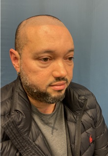 Hair Transplant Before Photo by Lisa Brostrom, MD; San Antonio, TX - Case 49843