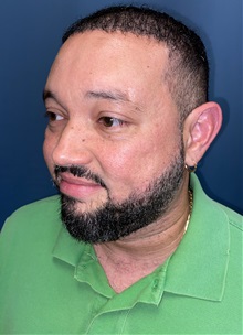 Hair Transplant After Photo by Lisa Brostrom, MD; San Antonio, TX - Case 49843