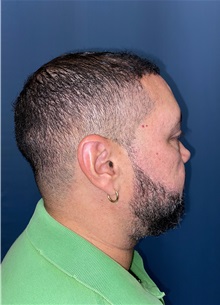 Hair Transplant After Photo by Lisa Brostrom, MD; San Antonio, TX - Case 49843