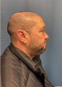Hair Transplant Before Photo by Lisa Brostrom, MD; San Antonio, TX - Case 49843