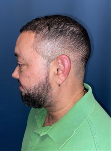 Hair Transplant After Photo by Lisa Brostrom, MD; San Antonio, TX - Case 49843