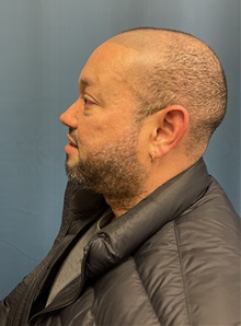 Hair Transplant Before Photo by Lisa Brostrom, MD; San Antonio, TX - Case 49843