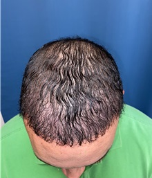 Hair Transplant After Photo by Lisa Brostrom, MD; San Antonio, TX - Case 49843