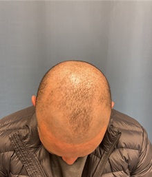 Hair Transplant Before Photo by Lisa Brostrom, MD; San Antonio, TX - Case 49843