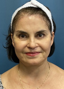 Brow Lift After Photo by Lisa Brostrom, MD; San Antonio, TX - Case 49851