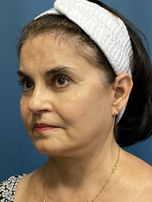 Brow Lift After Photo by Lisa Brostrom, MD; San Antonio, TX - Case 49851