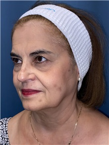 Brow Lift Before Photo by Lisa Brostrom, MD; San Antonio, TX - Case 49851