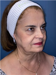 Brow Lift Before Photo by Lisa Brostrom, MD; San Antonio, TX - Case 49851