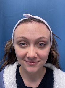 Brow Lift After Photo by Lisa Brostrom, MD; San Antonio, TX - Case 49850