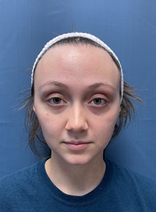 Brow Lift Before Photo by Lisa Brostrom, MD; San Antonio, TX - Case 49850