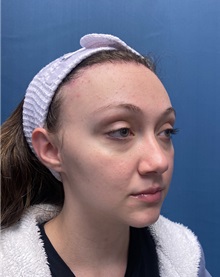Brow Lift After Photo by Lisa Brostrom, MD; San Antonio, TX - Case 49850