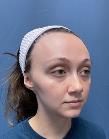 Brow Lift Before Photo by Lisa Brostrom, MD; San Antonio, TX - Case 49850