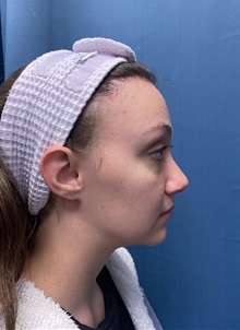 Brow Lift After Photo by Lisa Brostrom, MD; San Antonio, TX - Case 49850
